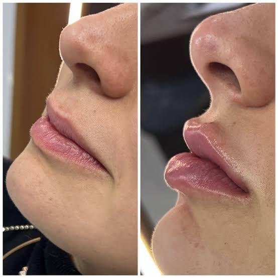 Resultado antes e depois