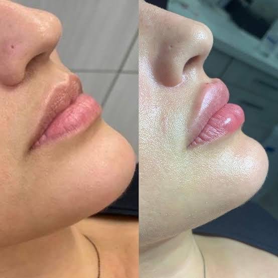 Resultado antes e depois